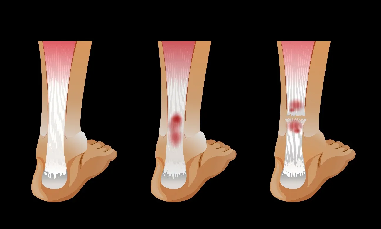 Tendiditis | FisioClinic Galapagar